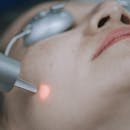 シミ取り放題におすすめのクリニック【そばかすも!2025年】