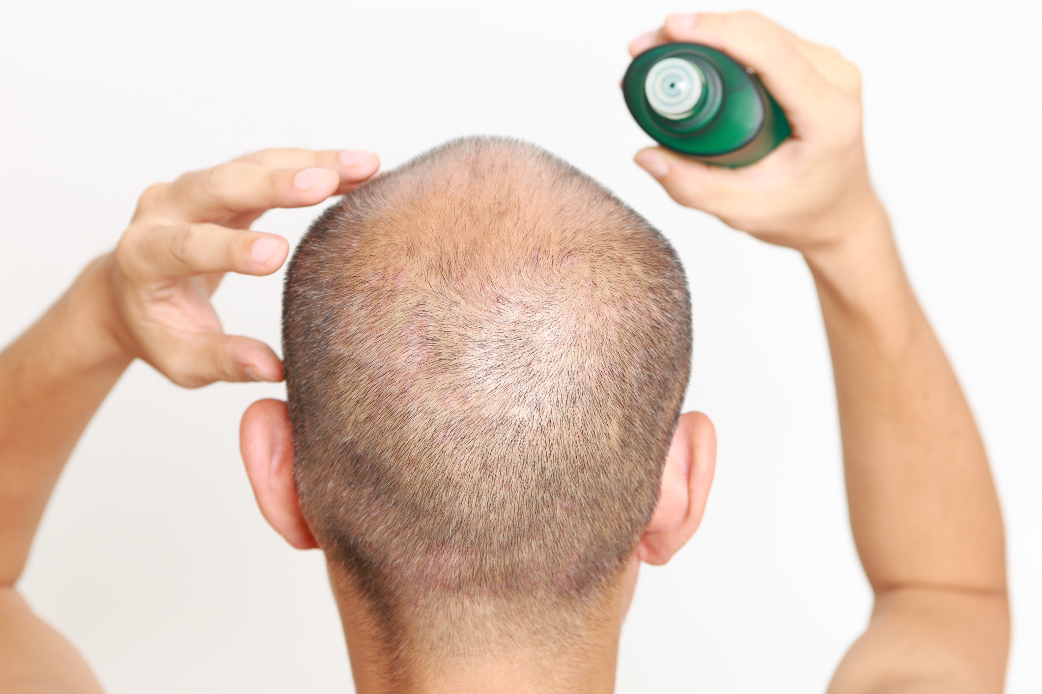 柳屋 薬用ヘアトニック フケ・かゆみ用を全37商品と比較!口コミや評判を実際に使ってレビューしました! | mybest 柳屋 薬用ヘアトニック フケ・かゆみ用を全37商品と比較!口コミや評判を実際に使ってレビューしました! | mybest