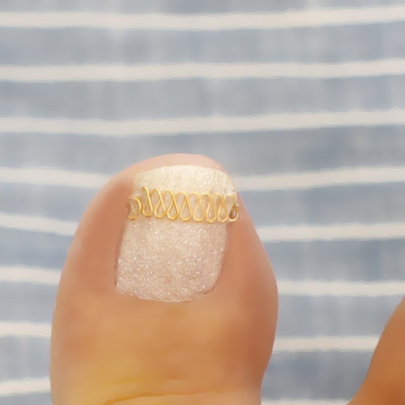 巻き爪ブロックの悪い口コミや評判は本当 実際に使って効果検証レビュー Mybest