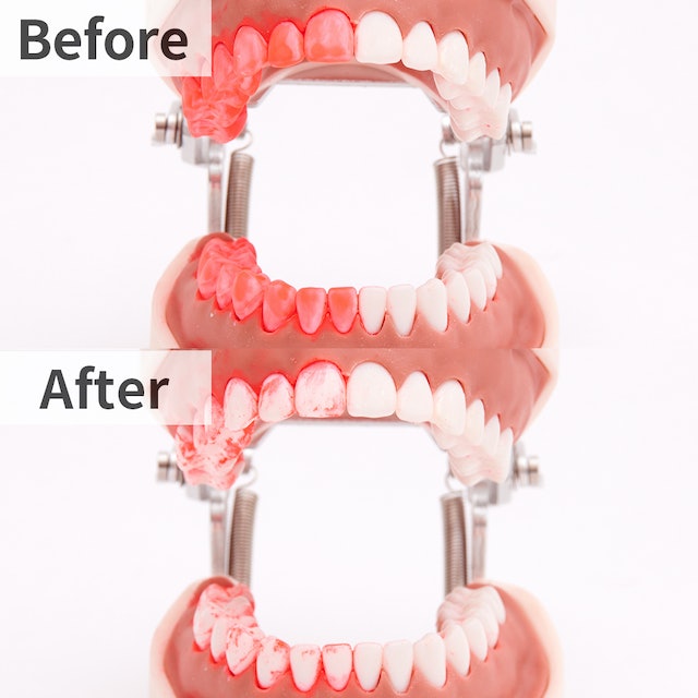 フィリップス ソニッケアー エキスパートクリーン 7500 HX9692を