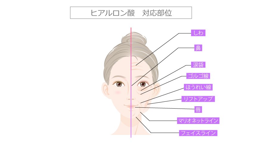 東京中央美容外科 ヒアルロン酸注射 6