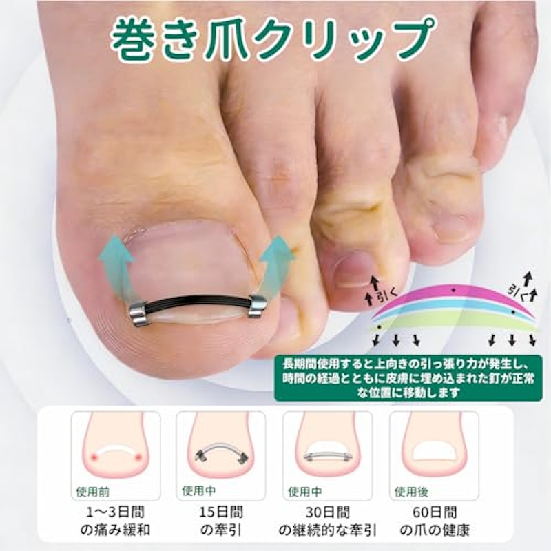 巻き爪クリップ 2