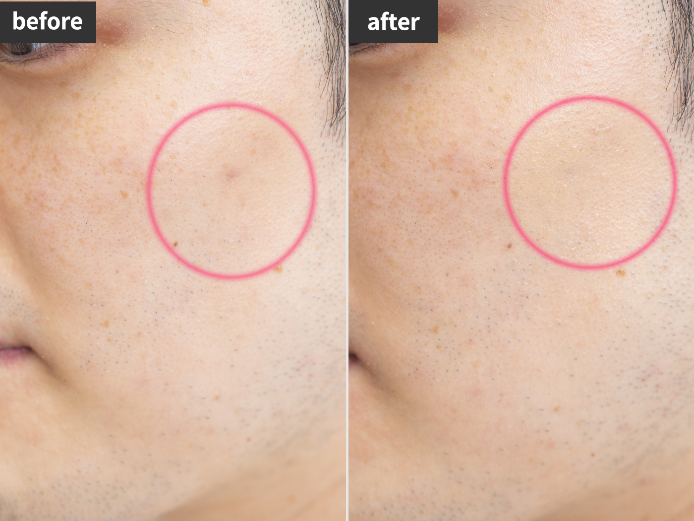 Dhc薬用アクネケア コンシーラーを他商品と比較 口コミや評判を実際に使ってレビューしました Mybest