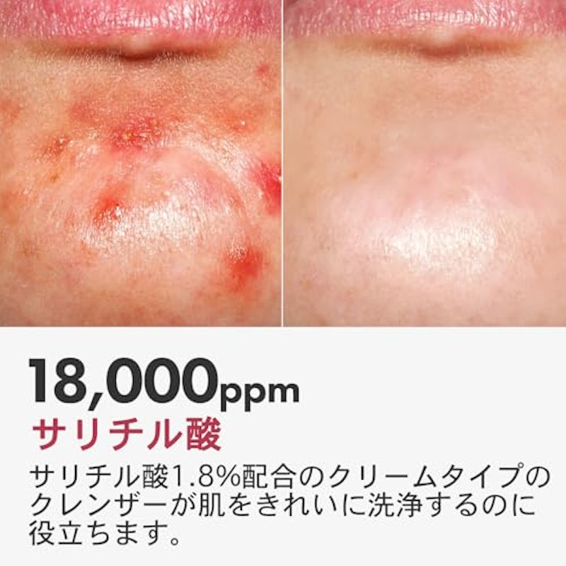 サリチル酸フォームクレンザー 3
