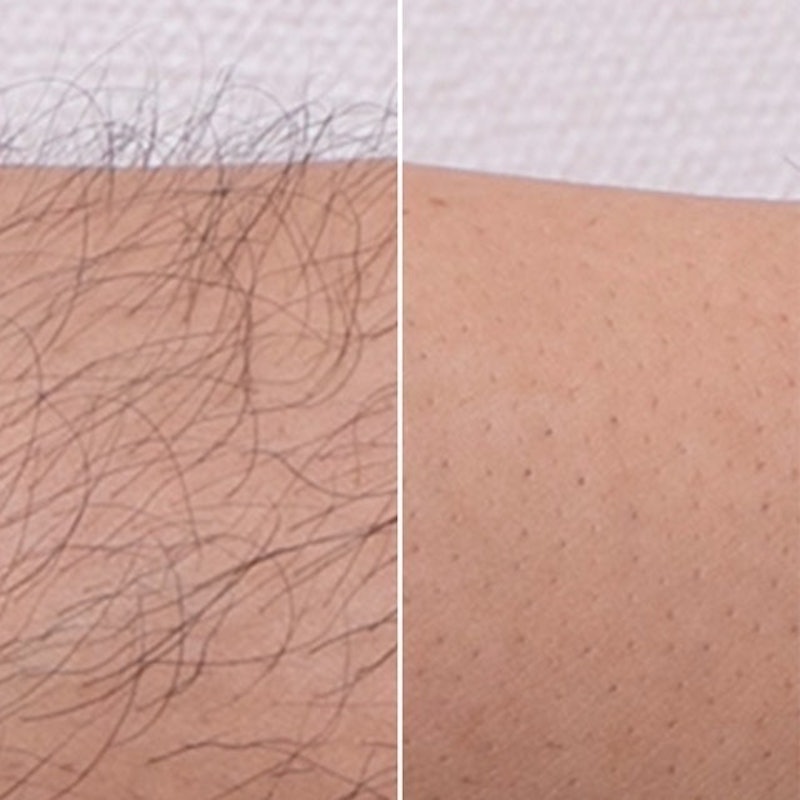 エピラット 脱毛 ハニー ゼリー