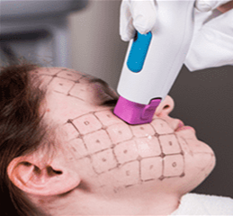 湘南美容クリニック サーマクール 2