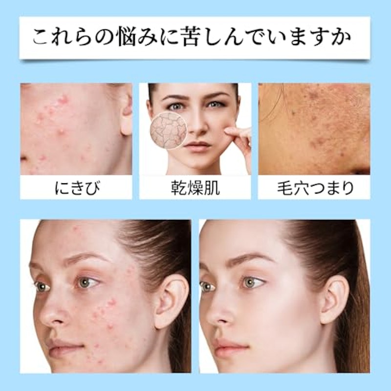 Azelaic Acid Acne Cream 3