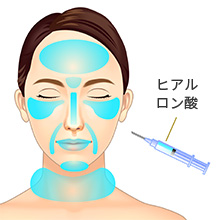 東京美容外科 ヒアルロン酸注射 3