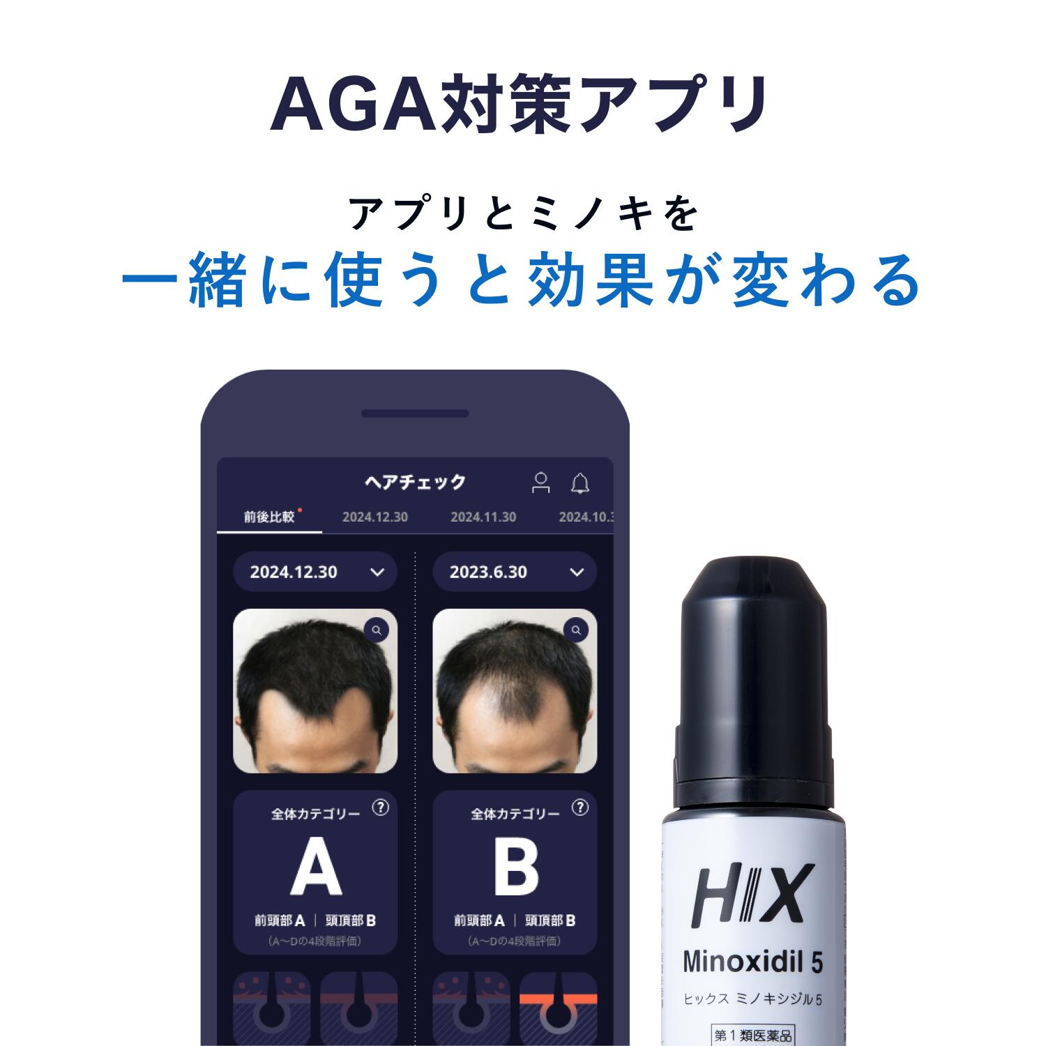ミノキシジル5 5
