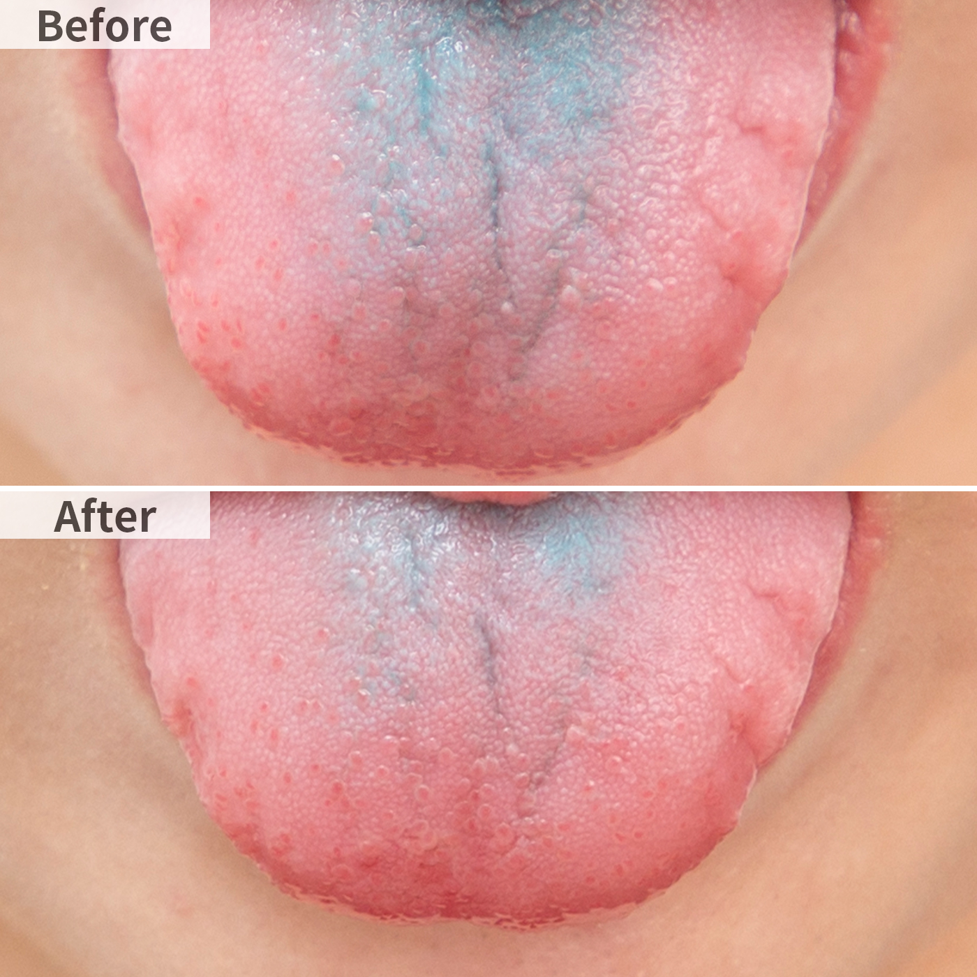 サンスター ガム歯周プロケア 舌ブラシを他商品と比較 口コミや評判を実際に使ってレビューしました Mybest