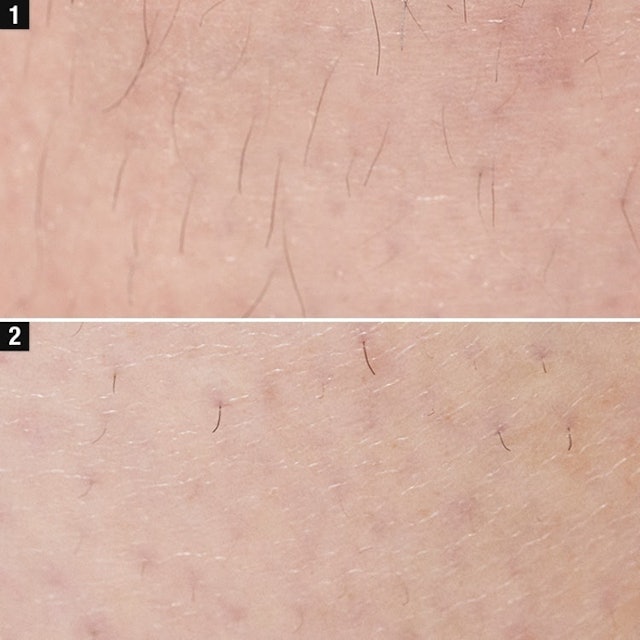 Ouday 脱毛器を全10商品と比較 口コミや評判を実際に使ってレビューしました Mybest