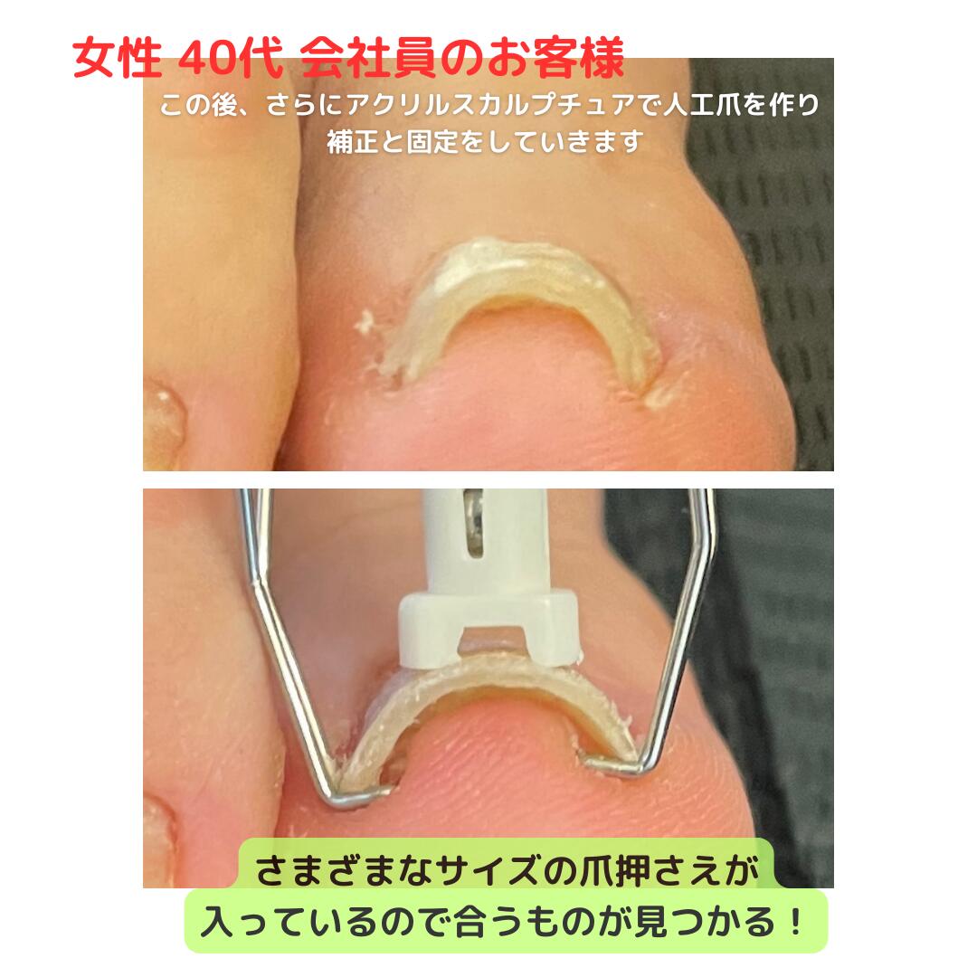 巻き爪マキちゃんセット 4