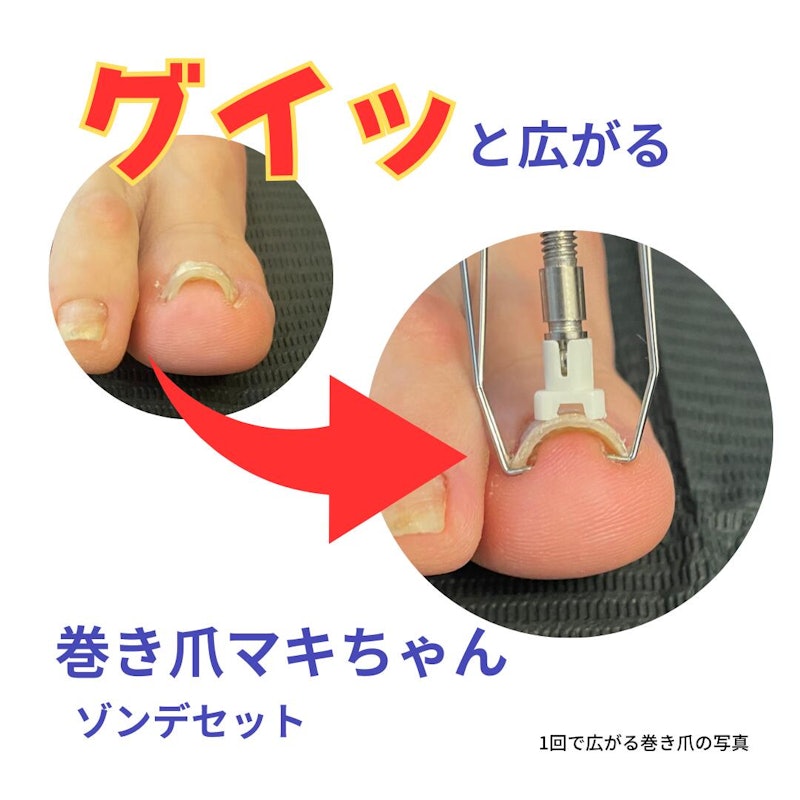 巻き爪マキちゃんセット 3