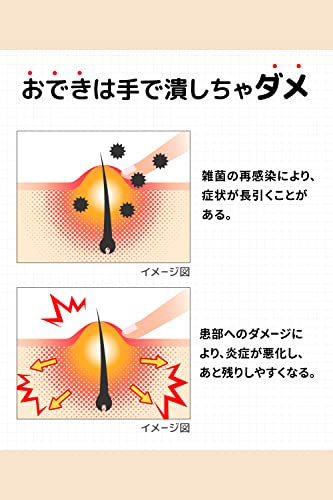 オデキュアEX　 6