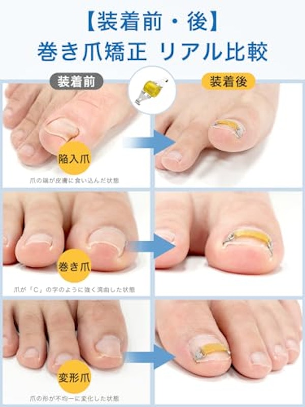 巻き爪矯正器具 5