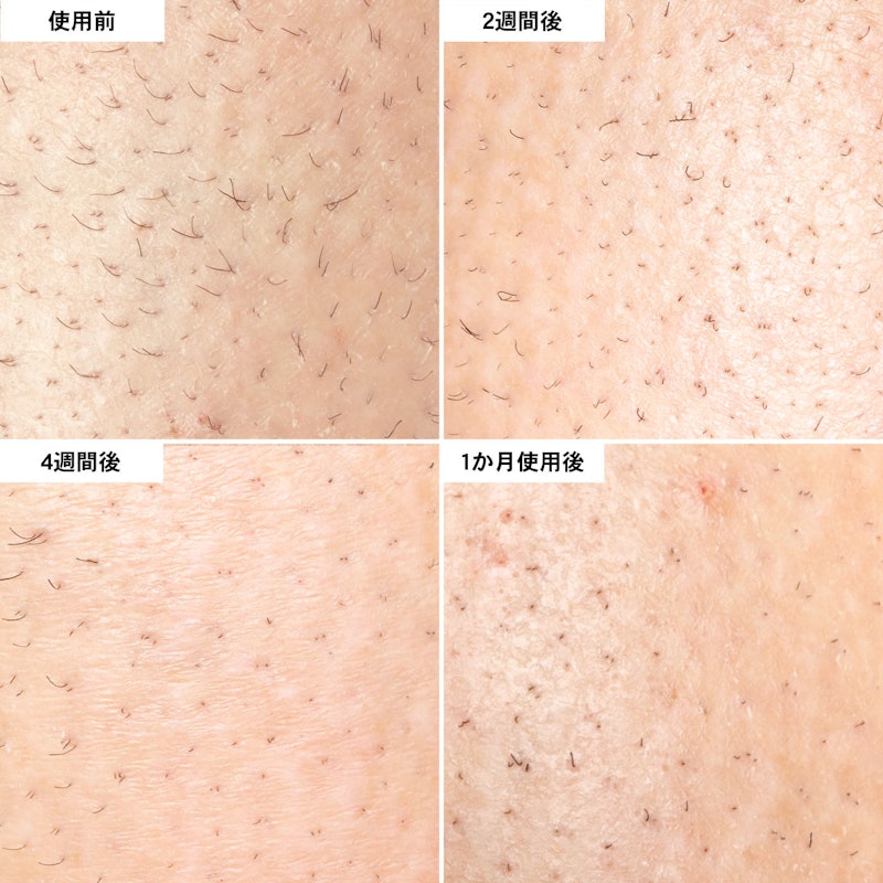 IPL脱毛器 9