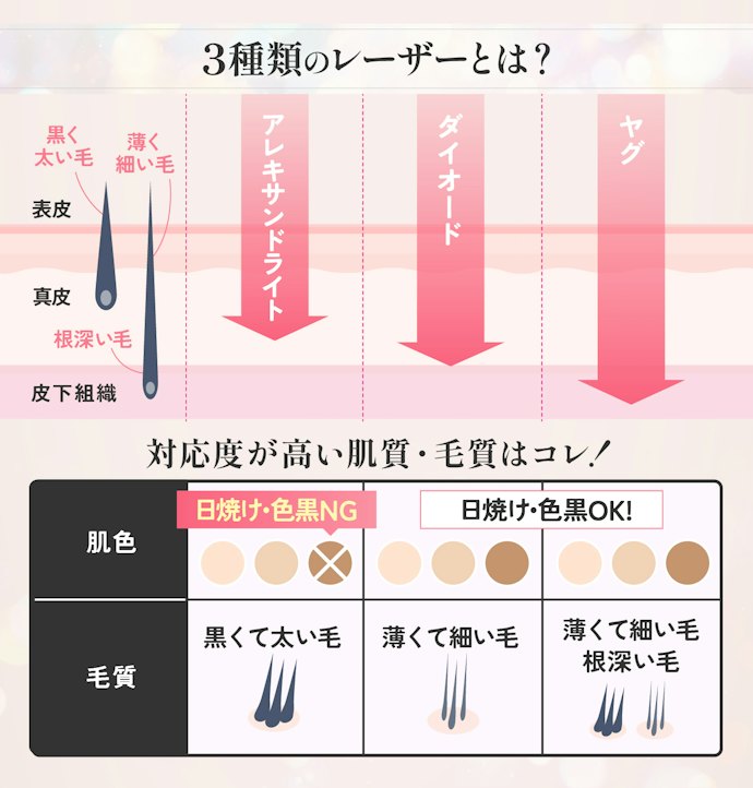 湘南美容クリニックのレーザー・脱毛機