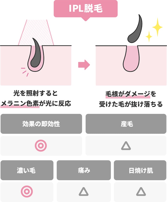 「IPL」は毛根にダメージを与え、濃い毛に効果が期待できる