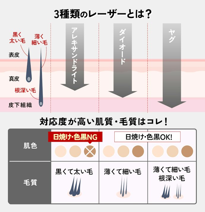 エミナルクリニックメンズのレーザー