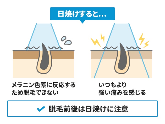 日焼けに注意!日焼け具合ではヒゲ脱毛できない場合も