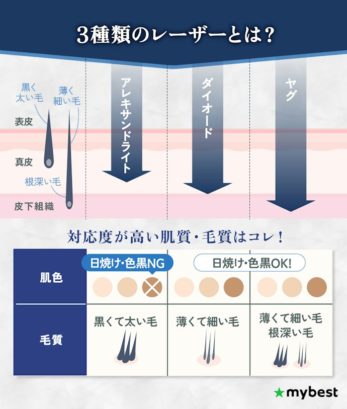 湘南美容クリニックメンズの脱毛機・レーザー
