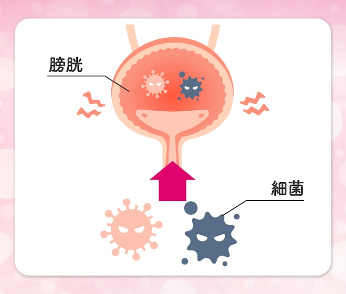 Q.そもそも、膀胱の炎症はどのような原因で起こるのでしょうか?