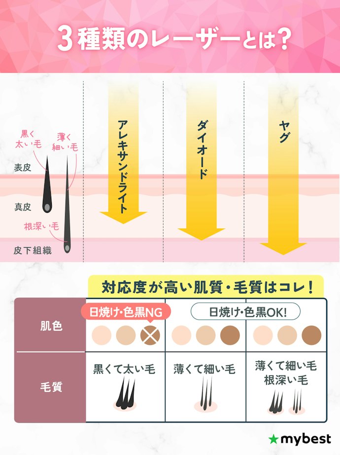 3種類のレーザーが使えるクリニックを選ぼう