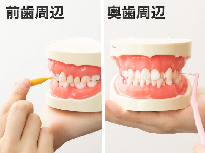 前歯はI字、奥歯にはL字で使い分けよう