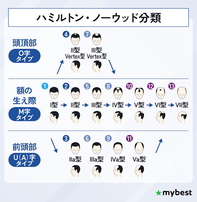 AGAの進行度はどう測る?自分の進行度を知るには?