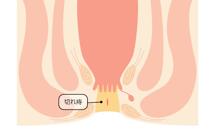 軽い切れ痔は自然治癒もありえる。ただし、原因が改善されなければ同じ場所が切れることに