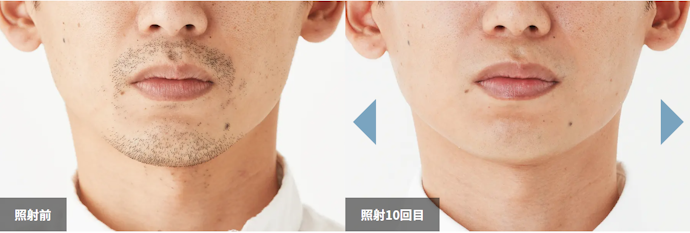 ツルツルを目指すなら「10回以上」必要になる可能性が高い