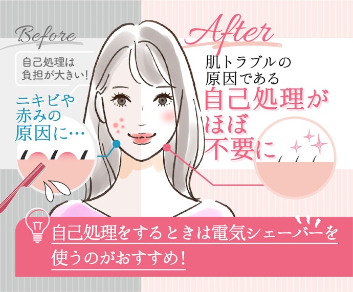 自己処理が減り、肌トラブルが軽減される