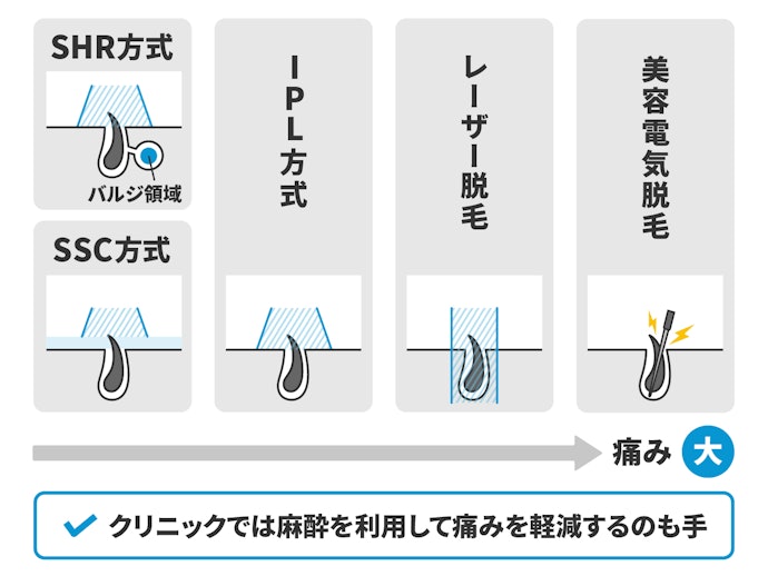 ヒゲはほかの部位より痛みを感じやすい。痛みに弱い人は麻酔が使える医療クリニックも検討