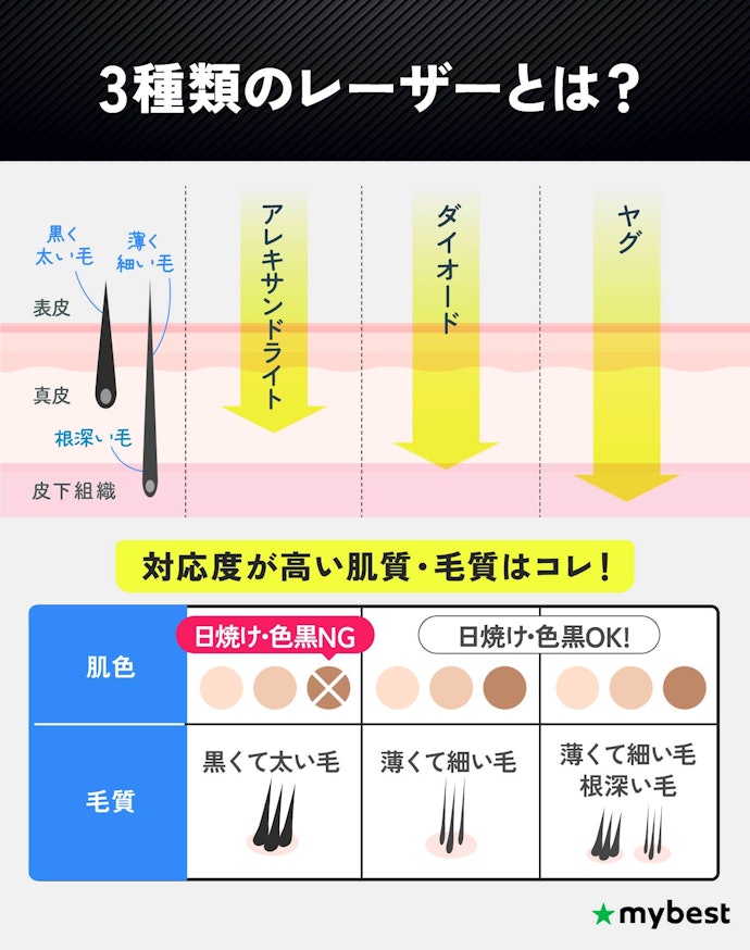 3種類のレーザーが使えるクリニックを選ぼう