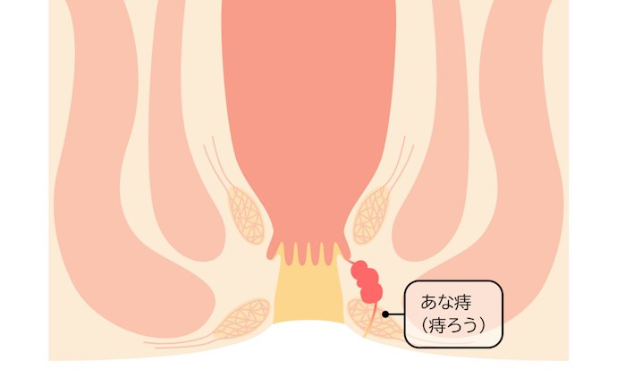 痔瘻の自然治癒は難しい。手術が必要なので受診して