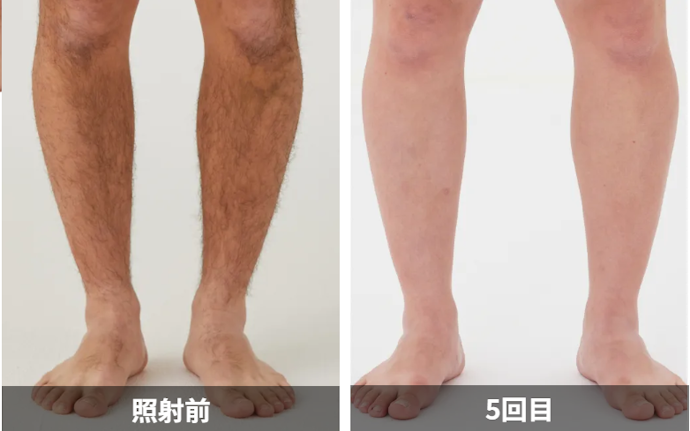 メンズリゼの足脱毛のよい点