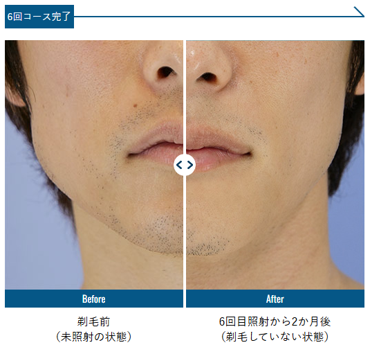湘南美容クリニックのヒゲ脱毛のよい点