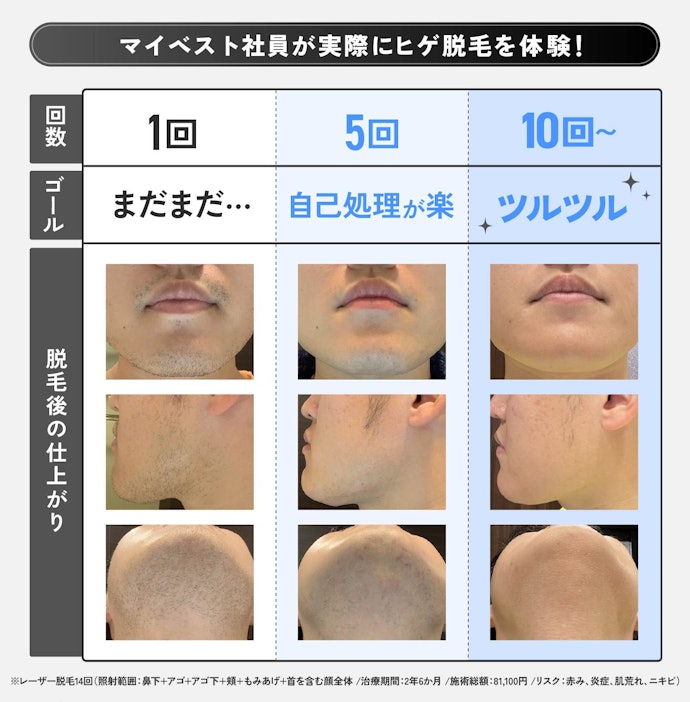 ヒゲ脱毛は何回くらいで終わる?