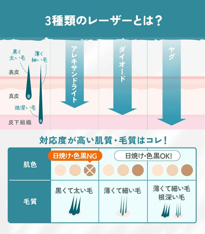 3種類のレーザーを導入