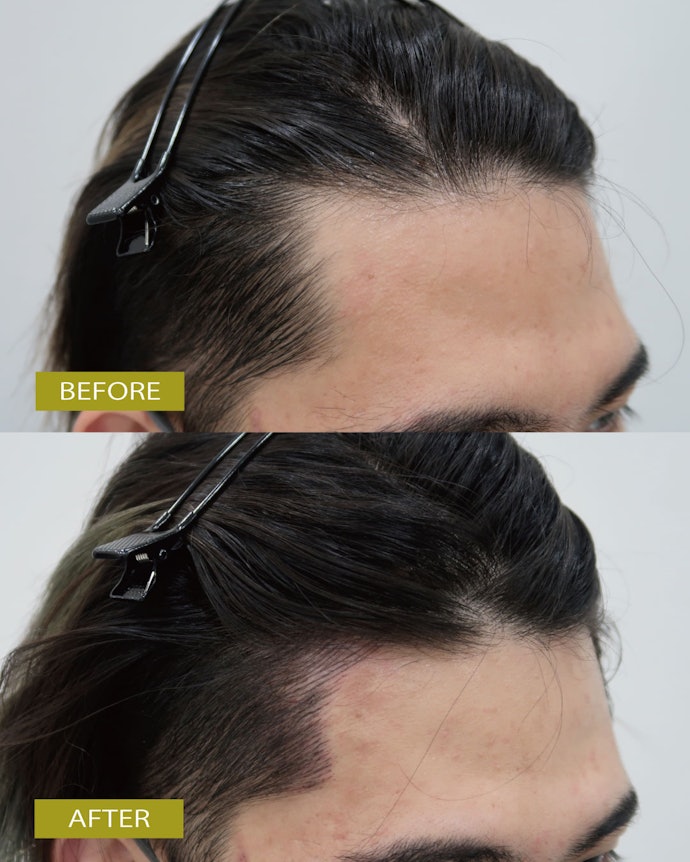 ヘアラインを整えたいなら、薄毛治療も行っているクリニックがおすすめ
