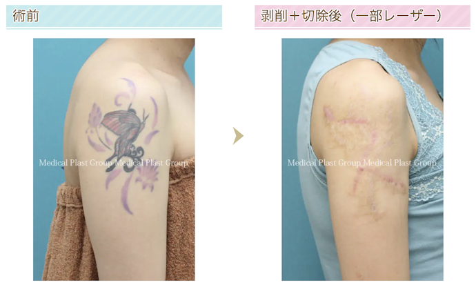 剥削(はくさく)法:レーザーが効きにくい・使用できない人に