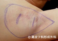 効果重視なら剪除法やクワドラカット法など、汗腺切除の施術が候補
