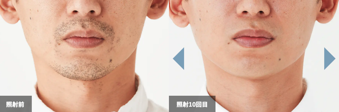 ツルツルを目指すなら「10回以上」必要になる可能性が高い