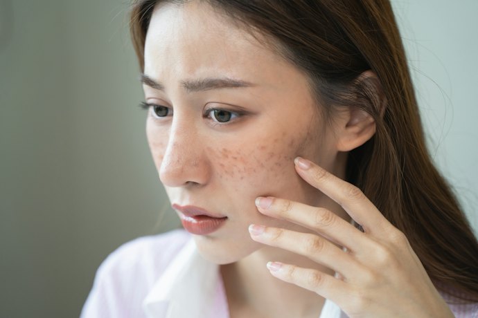 シミ・そばかすを防ぎたいなら、美白有効成分トラネキサム酸配合の医薬部外品を