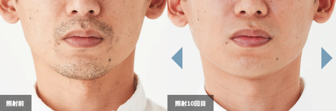 ツルツルを目指すなら「10回以上」必要になる可能性が高い
