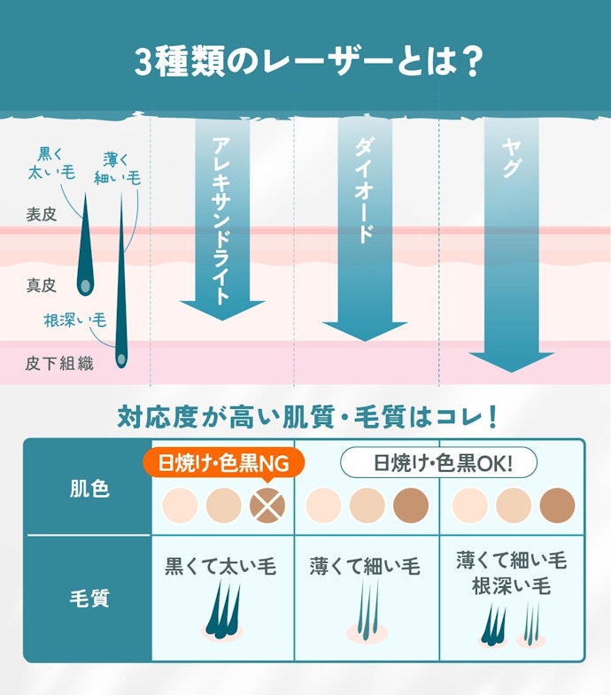 毛質に合わせて3種類のレーザーを使い分け