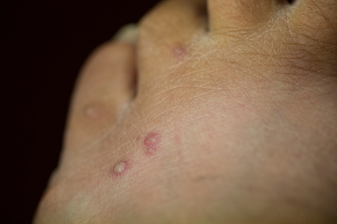 ダニ刺されによる化膿を抑えたいなら、抗生物質配合がおすすめ
