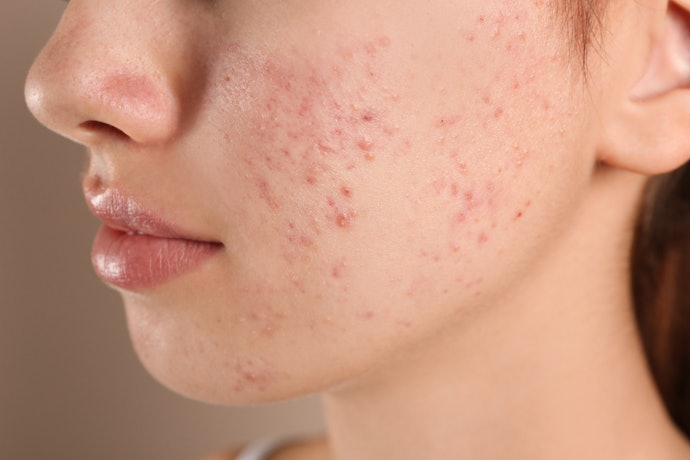 ベタつきやすい脂性肌・ニキビができやすい肌なら、皮脂吸着+抗炎症有効成分に注目