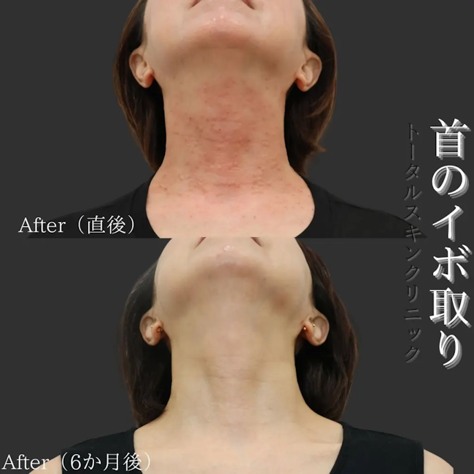 首のイボも気になる人は保険診療ができる皮膚科を選ぼう