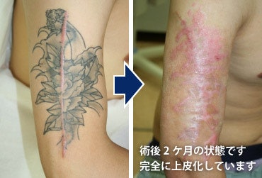 皮膚移植・植皮:広範囲のタトゥーを消したい人に